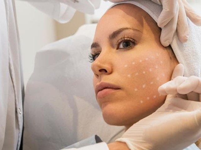 Mesoterapia facial para revitalizar o rostro