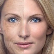 Radiesse: lifting facial sin cirugía